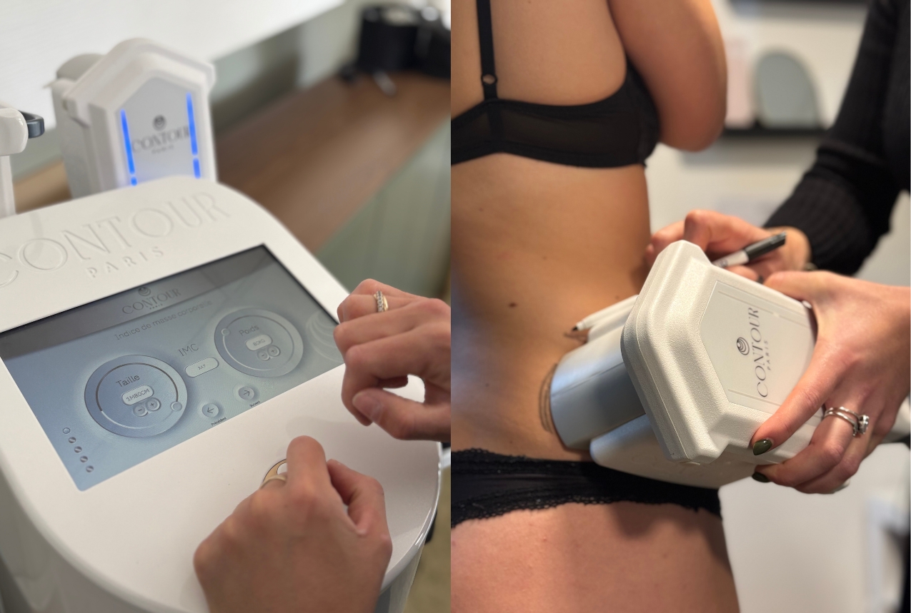 cryolipolyse a caen
